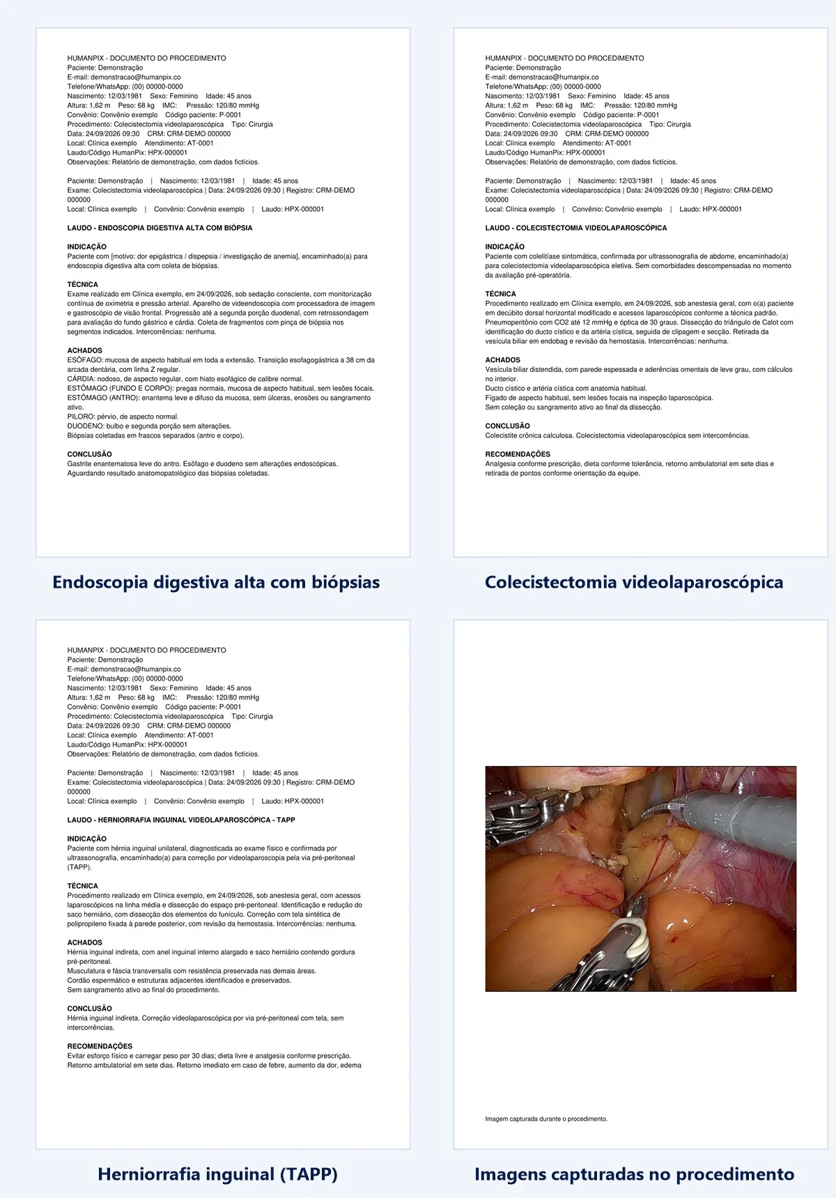 Quatro folhas de laudo geradas pela biblioteca do HumanPix: endoscopia digestiva alta com bi&oacute;psias, colecistectomia videolaparosc&oacute;pica, herniorrafia inguinal (TAPP) e uma folha com as imagens capturadas no procedimento